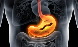 Mide kanseri belirtileri neler? Erken uyarı işaretlerine dikkat