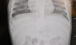 Sırtüstü Yatınca Ağlayan Bebeğin Sırtından Tel Çıktı