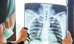 Uzmanlardan Zatürre Uyarısı, Sessiz İlerleyen Akciğer Tehlikesi