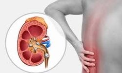 Böbrekte Kum Neden Olur, Nasıl Temizlenir?