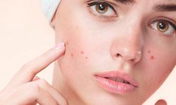 Sivilce Nasıl Geçer? Sivilce İzleri Nasıl Geçer? Cilt Sağlığı İçin Öneriler