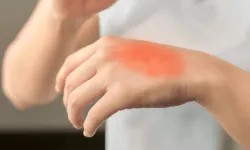 Yanığa Ne İyi Gelir? Evde İlk Yardım Yöntemleri