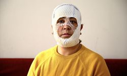 Adana'da cilt bakımı sonrası yüzünde yanık oluştuğunu iddia eden kadın şikayetçi oldu