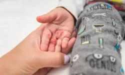 Osmaniye'de çocuklarda yaz aylarında el ayak ağız hastalığı!
