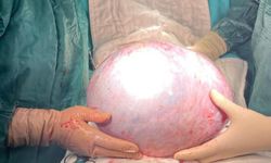 Doktorlar İlk Kez Gördü! Karnında Tam 6,5 kiloluk Tümör Çıktı