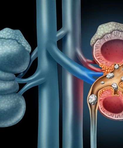Böbrek Taşı Olanlar Dikkat: Ağrıyı Azaltan ve Taşı Düşüren Yöntemler