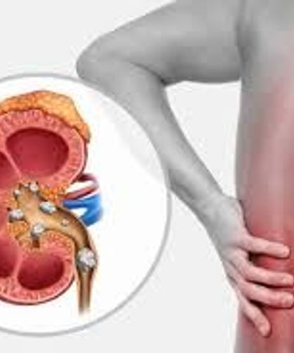 Böbrekte Kum Neden Olur, Nasıl Temizlenir?