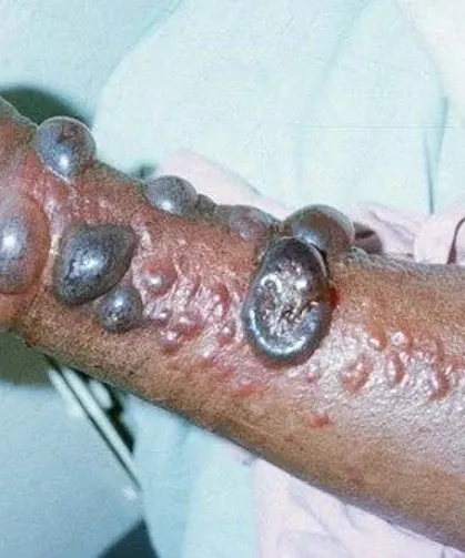 Ebola Salgınında Alarm Seviyesi Yükseldi Ölümler Yükseldi