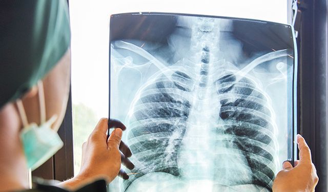 Uzmanlardan Zatürre Uyarısı, Sessiz İlerleyen Akciğer Tehlikesi