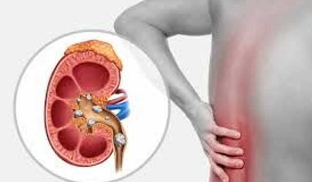 Böbrekte Kum Neden Olur, Nasıl Temizlenir?