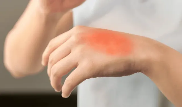 Yanığa Ne İyi Gelir? Evde İlk Yardım Yöntemleri