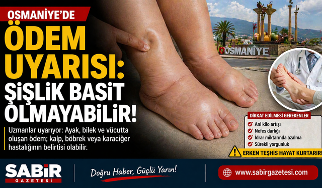 Osmaniye’de Ödem Uyarısı: Şişlik Basit Olmayabilir