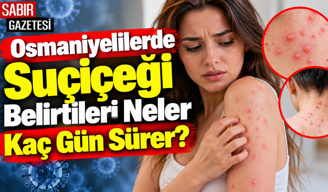 Osmaniyelilerde Suçiçeği Belirtileri Neler Kaç Gün Sürer?