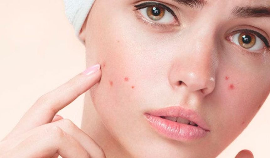 Sivilce Nasıl Geçer? Sivilce İzleri Nasıl Geçer? Cilt Sağlığı İçin Öneriler