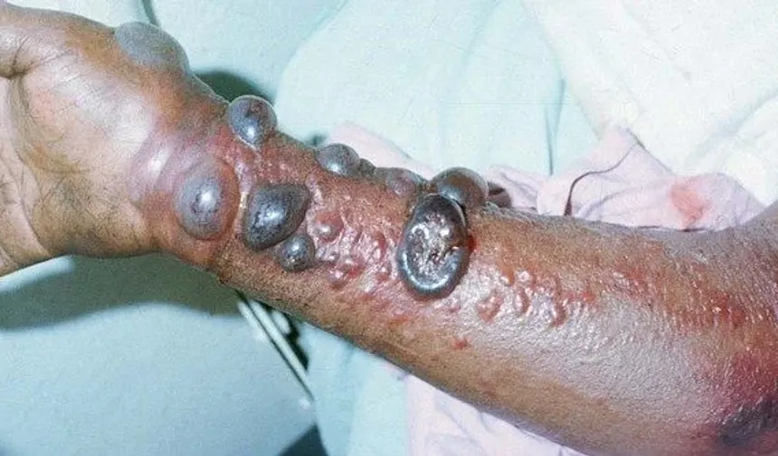 Ebola Salgınında Alarm Seviyesi Yükseldi Ölümler Yükseldi
