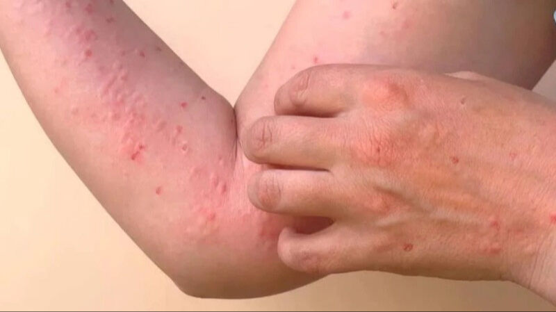 Chikungunya Virus Nedir Bulasici Mi Olumcul Mu Dunya Saglik Orgutu Uyardi 17533454697684 2