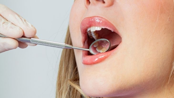 Diş Sararması Neden Olur2