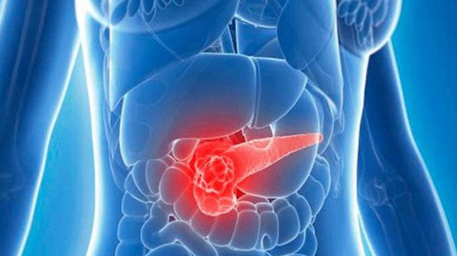 Pankreas Kanseri-1