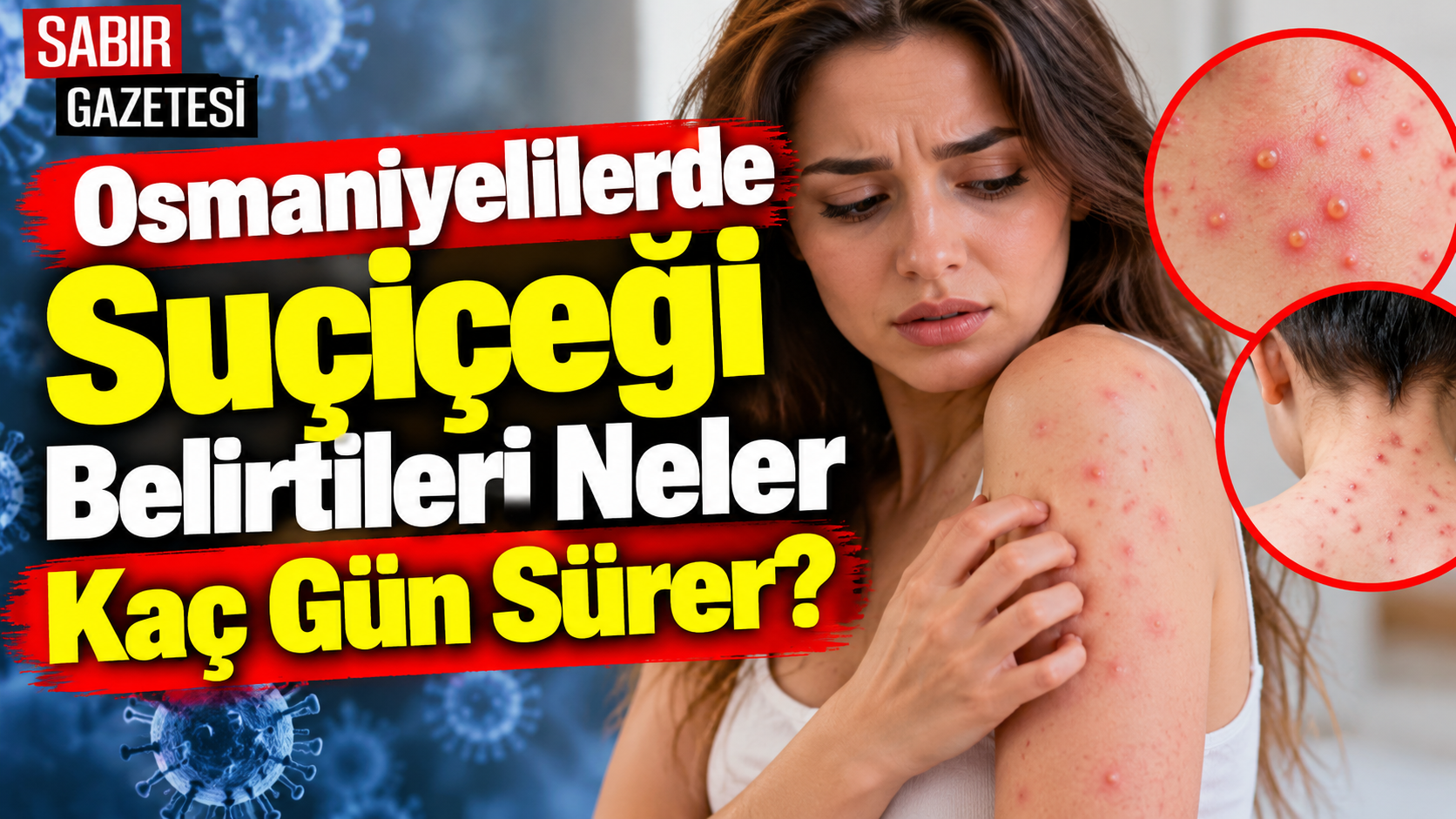 Osmaniyelilerde Suçiçeği Belirtileri Neler Kaç Gün Sürer?